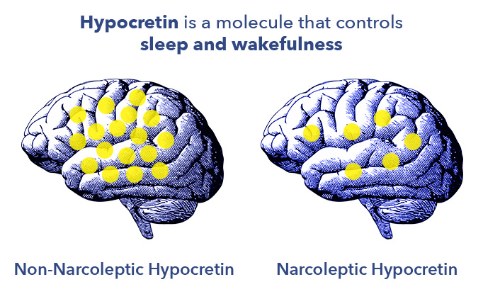 SO Hypersomnia Hypocretin