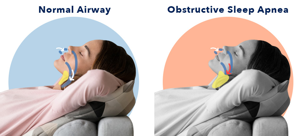 Imaging of Upper Airway Sleep Apnea. Moderate obstructive Sleep Apnea (ahi-19.9 /h). Sleep Apnea influence nervous System.