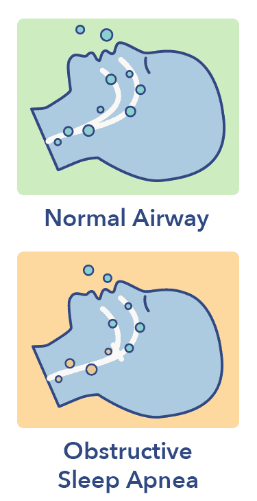 Sleep Apnea | Sleepopolis