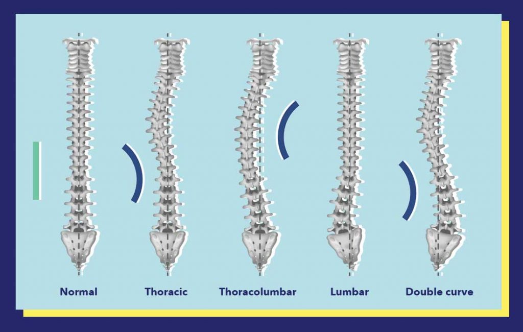 Can You Get Scoliosis From Sleeping on the Floor?