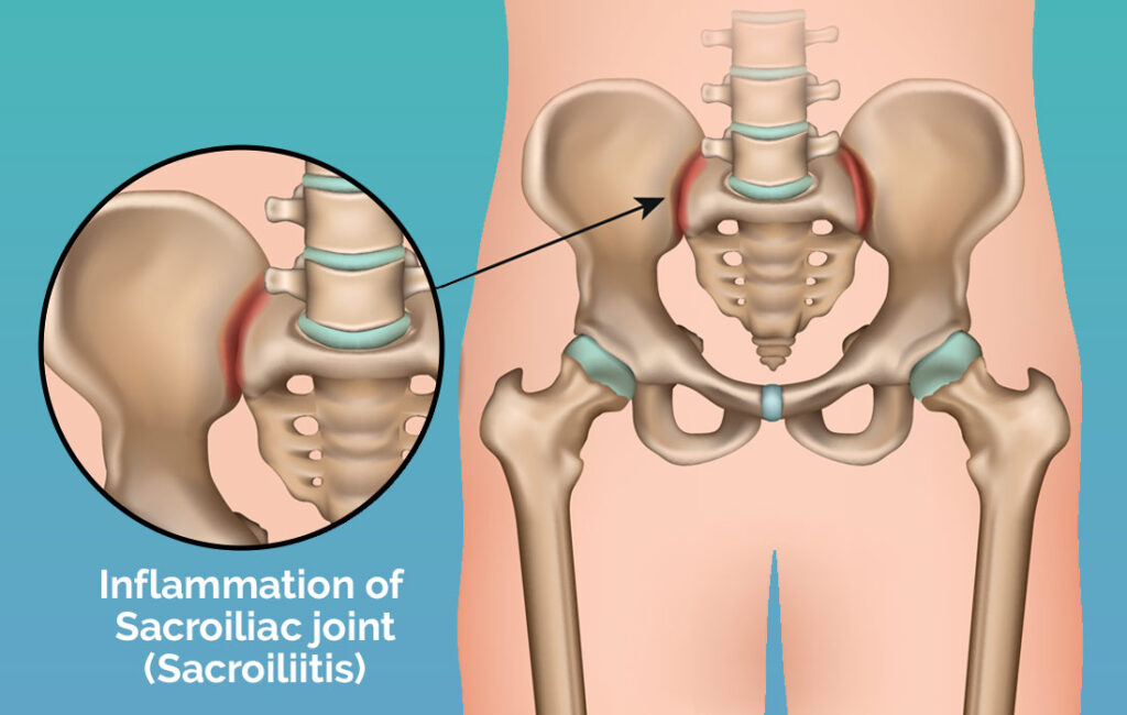 How to sit with SI joint pain: Posture and more